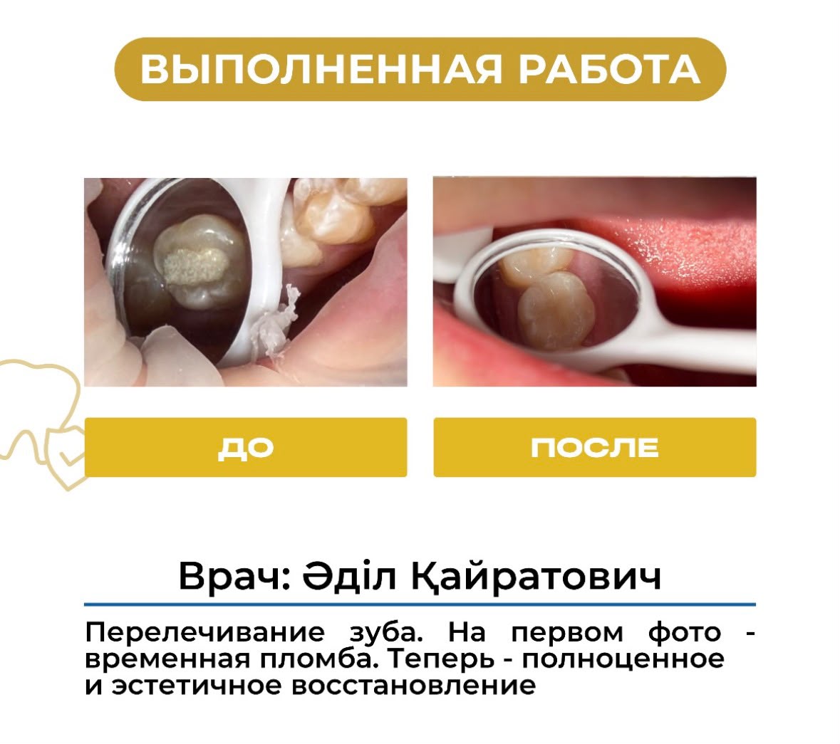 Работа до и после: перелечивание зуба